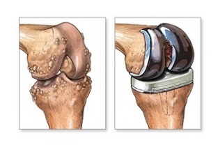 Αντικατάσταση γόνατος για οστεοαρθρίτιδα