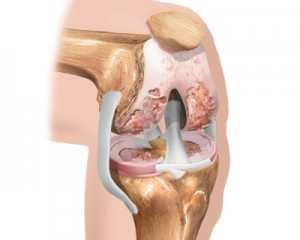 το αρχικό στάδιο της οστεοαρθρίτιδας του γόνατος